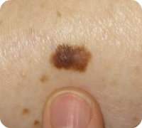 Skin Cancer Pictures & Melanoma Pictures - SkinHealth UK