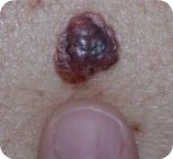 Nodular Melanoma