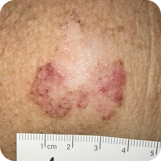 Superficial Basal Cell Carcinoma