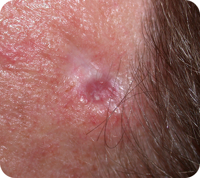 Morphoeic Basal Cell Carcinoma