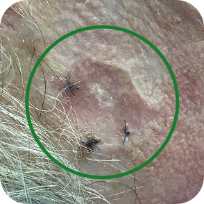 Morphoeic Basal Cell Carcinomas