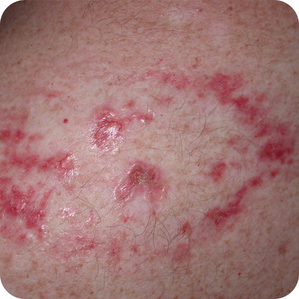 Multifocal Basal Cell Carcinoma