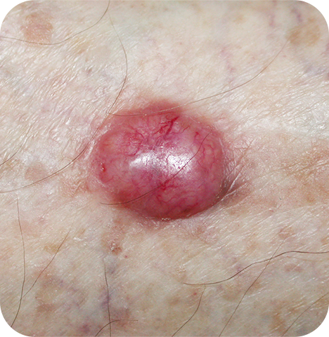 Nodular Basal Cell Carcinoma