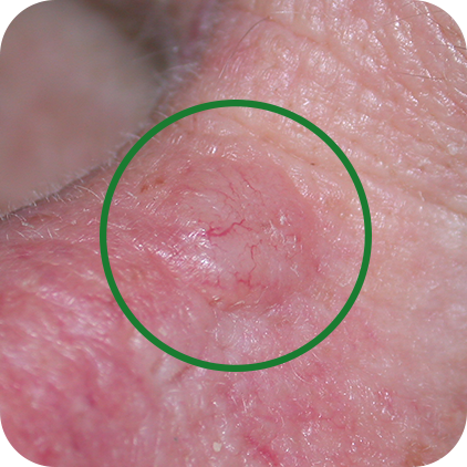 Nodular Basal Cell Carcinoma