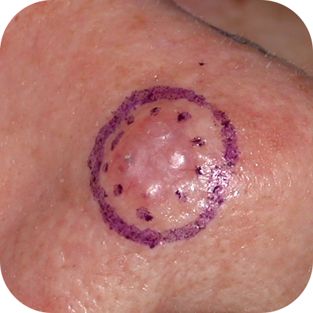 Nodular Basal Cell Carcinoma