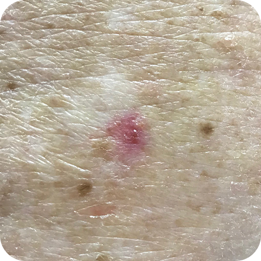 Superficial Basal Cell Carcinoma