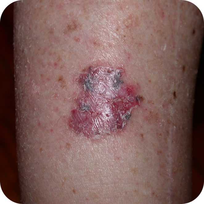 Superficial Basal Cell Carcinoma