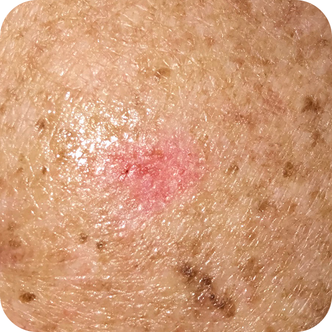 Superficial Basal Cell Carcinoma