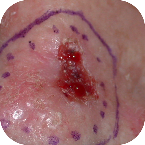 Ulcerated Basal Cell Carcinoma