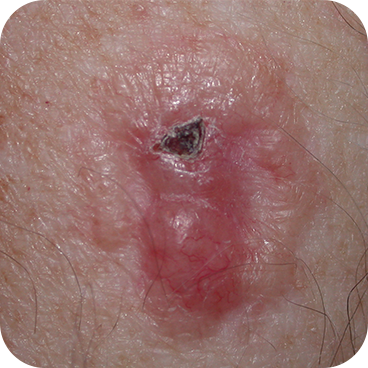 Ulcerated Basal Cell Carcinoma