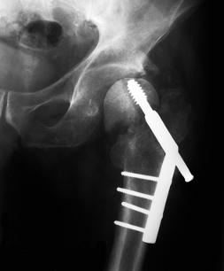 osteoporosis and cycling
