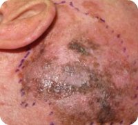 Superficial Spreading Melanoma