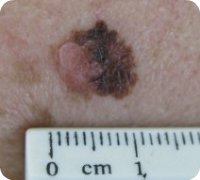 Superficial Spreading Melanoma