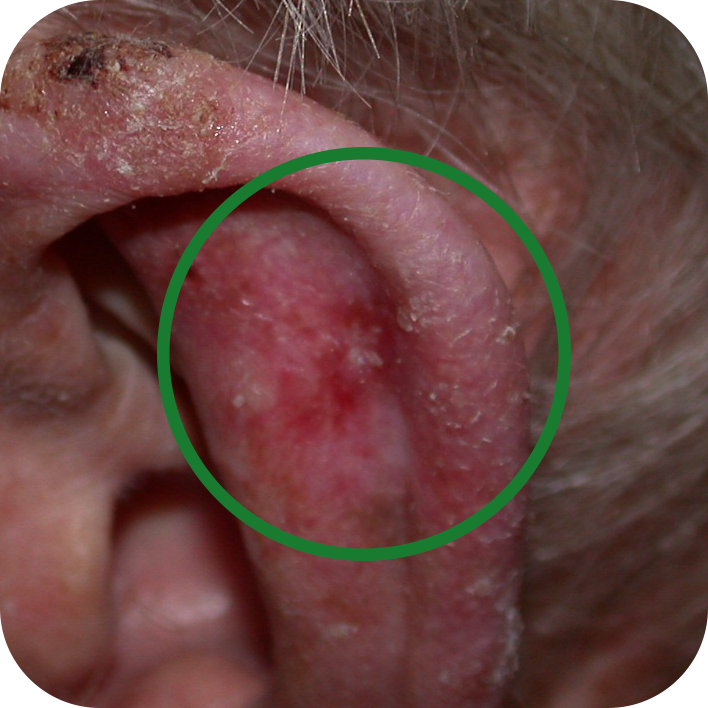 Amelanotic Melanoma