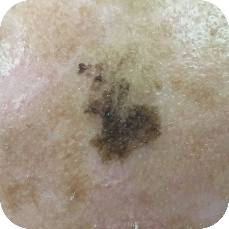 Lentigo Maligna Melanoma