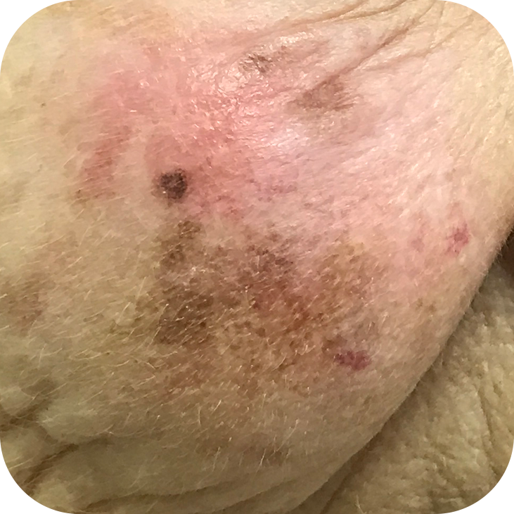 Lentigo Maligna Melanoma