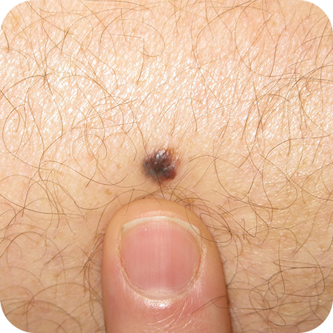 Nodular Melanoma