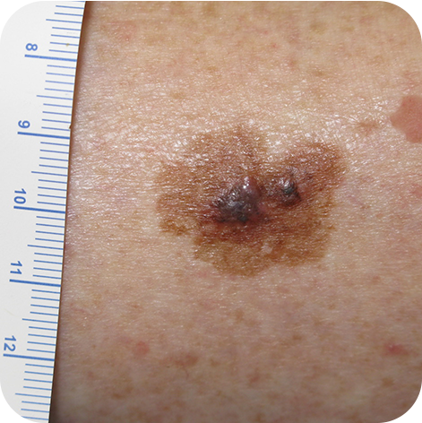 Nodular Melanoma