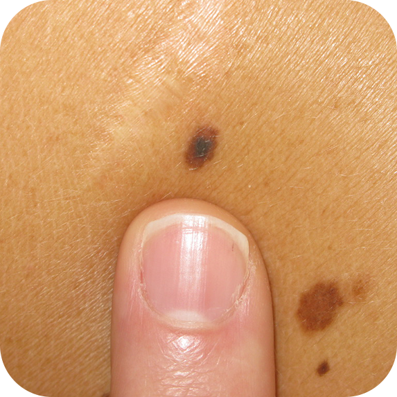 superficial spreading malignant melanoma