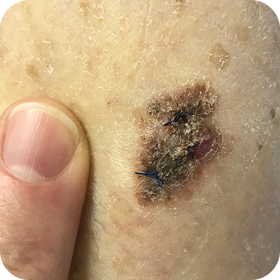 Superficial Spreading Melanoma