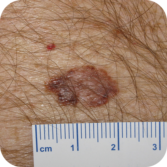 Superficial Spreading Melanoma