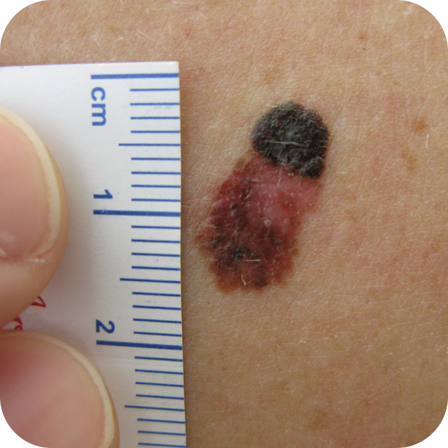 Superficial Spreading Melanoma