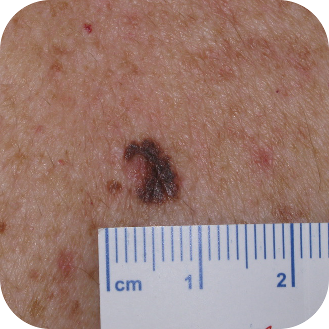 Superficial Spreading Melanoma