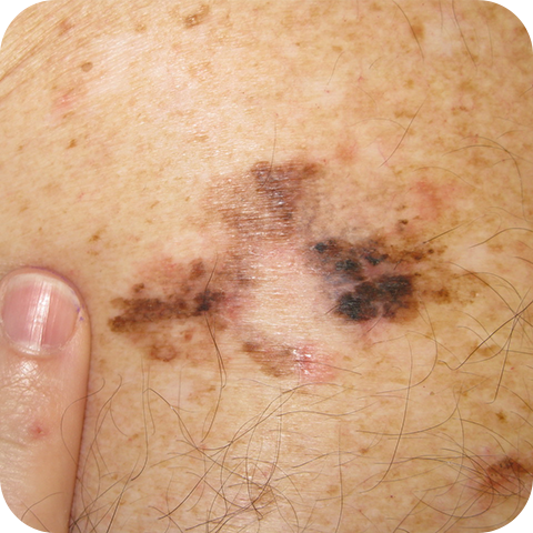 Superficial Spreading Melanoma