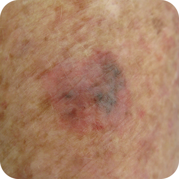 Superficial Spreading Melanoma