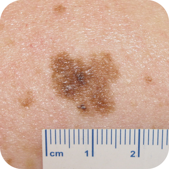 Superficial Spreading Melanoma