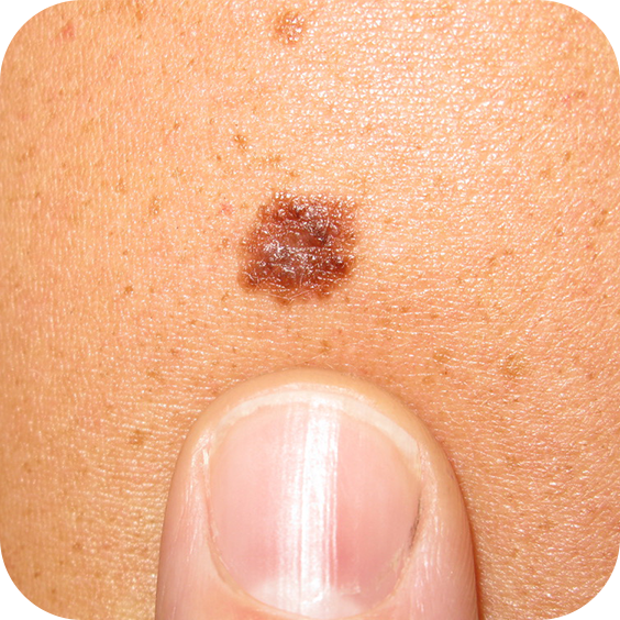 Superficial Spreading Melanoma