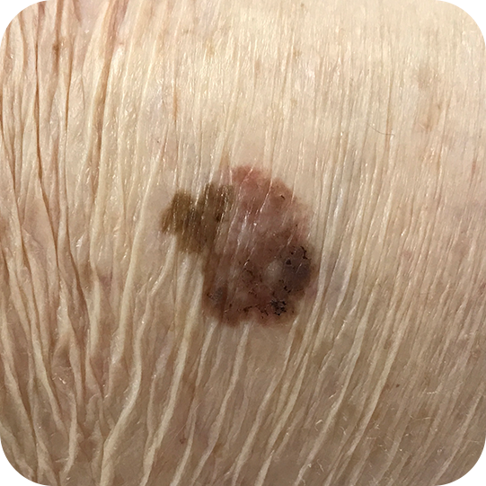 Superficial Spreading Melanoma