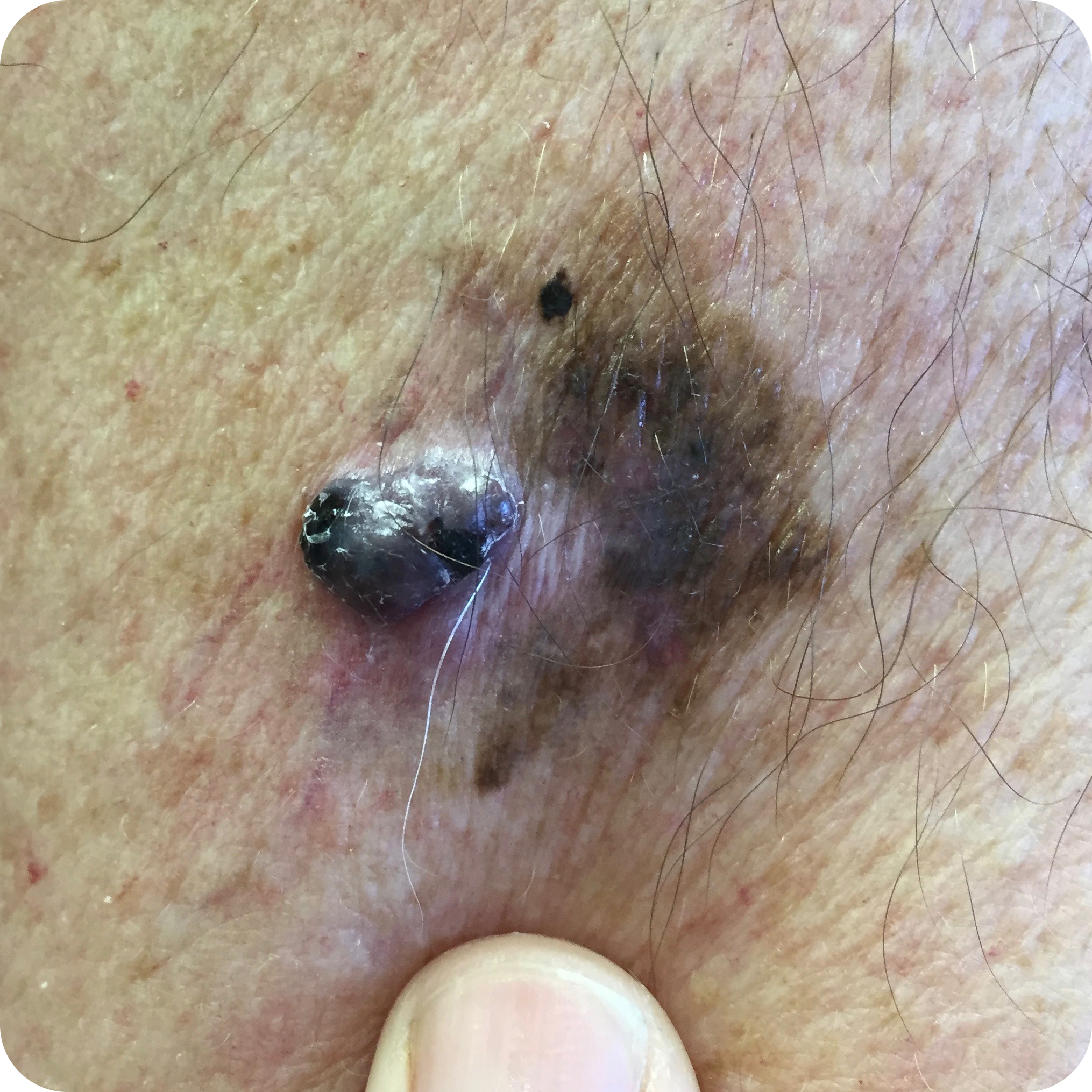 Nodular Melanoma