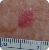 Amelanotic Melanoma