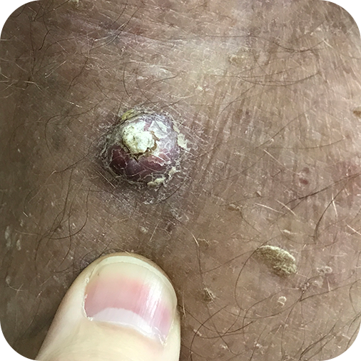 Invasive Squamous Cell Carcinoma