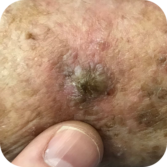 Invasive Squamous Cell Carcinoma