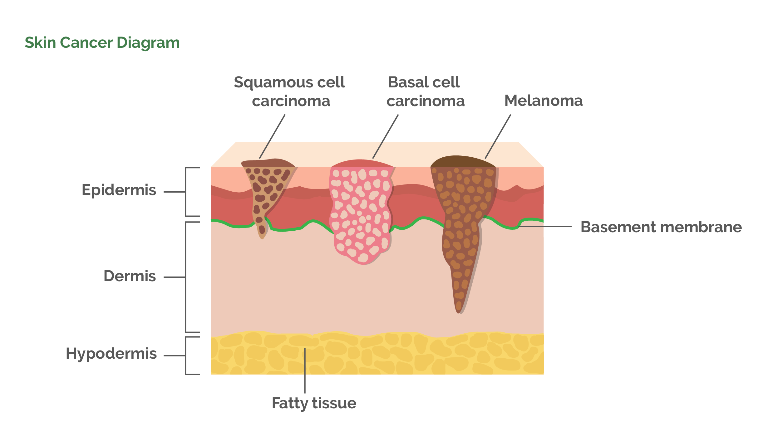 Skin Cancer Diagram