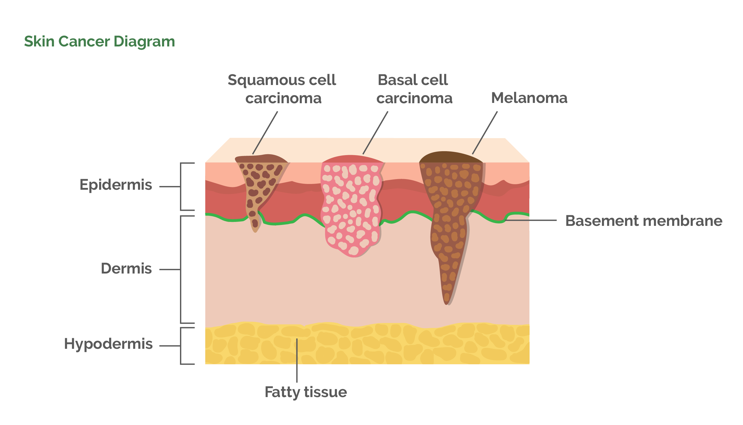 Melanoma Skin Cancer Diagram